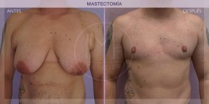 Before and after pictures of Mastectomy treatment